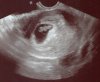 ultrasound aug 13.jpg